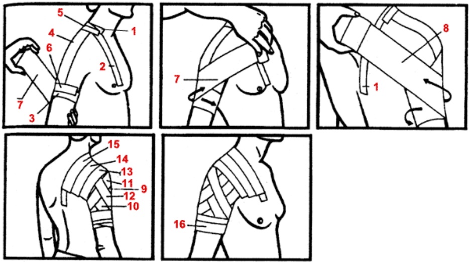 Схема тейпирования плечевого сустава