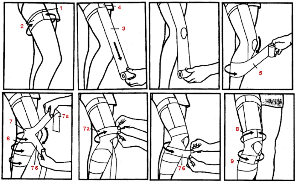 Как бинтовать колено. Тейпирование голени схема. Тейпирование колена схема. Тейпирование стопы схема. Тейпирование коленного сустава схема.