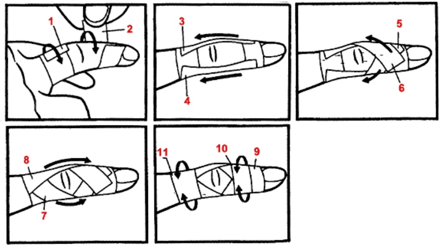 Тейпирование запястья схема
