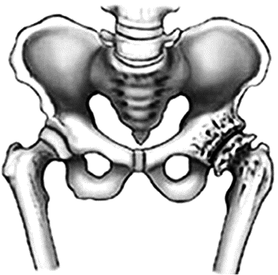 Остеоартроз крестцово-подвздошных сочленений. Дисплазия пателлофеморального сочленения. Как выглядит шейка бедра скелет.
