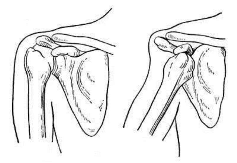 Вывих плечевого сустава картинки