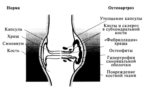 Остеоартроз патогенез