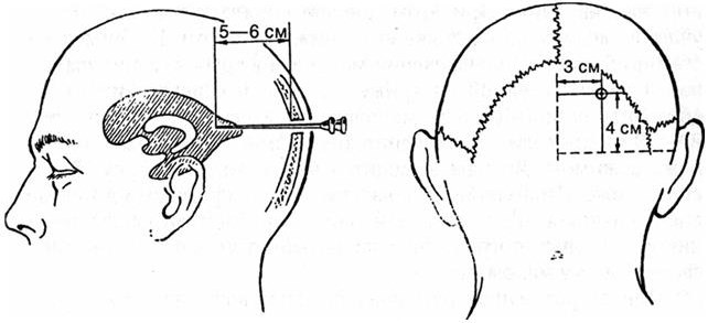 Пункция мозга. Пункция переднего и заднего рога бокового желудочка. Точка кохера пункция переднего рога. Пункция переднего рога бокового желудочка мозга. Точка пункции заднего рога бокового желудочка.