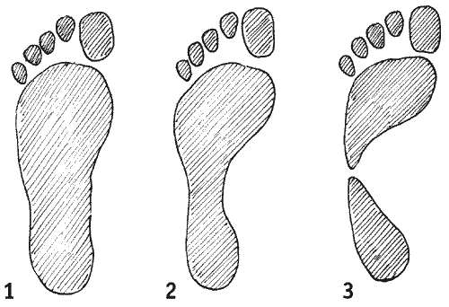 Правильный след. Плантография поперечного плоскостопия. Продольное плоскостопие 2 степени отпечаток. Отпечаток стопы при плоскостопии 2 степени. Поперечное плоскостопие по отпечатку стопы.