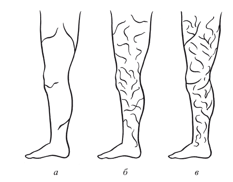 Варикоз на ногах рисунок