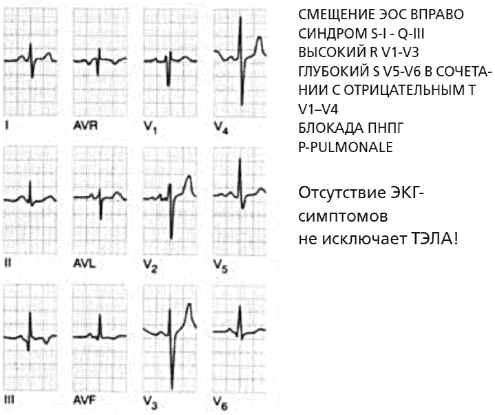 Перегрузка желудочков на экг. Перегрузка правого желудочка сердца на ЭКГ. Признаки перегрузки правого желудочка на ЭКГ. Перегрузка правого желудочка на ЭКГ. ЭКГ признаки острой перегрузки правого желудочка.