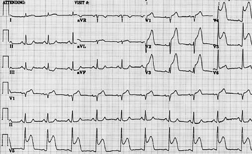 Экг острый инфаркт миокарда картинки