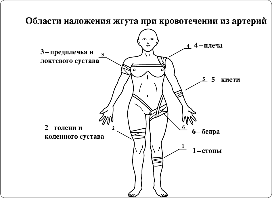 Схема наложения жгута