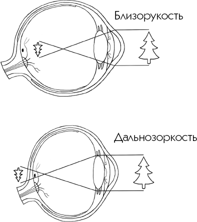 Рисунок близорукости и дальнозоркости