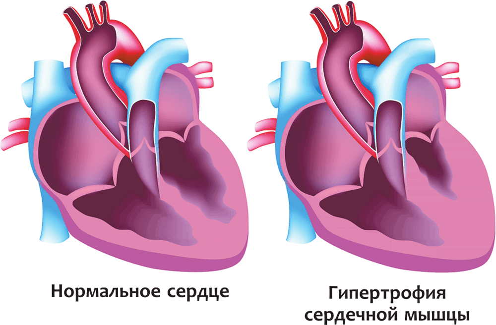 Гипертрофия желудочков сердца — сердце. Спортивное сердце гипертрофия миокарда. Гипертрофия миокарда у спортсменов. Синдром спортивного сердца.