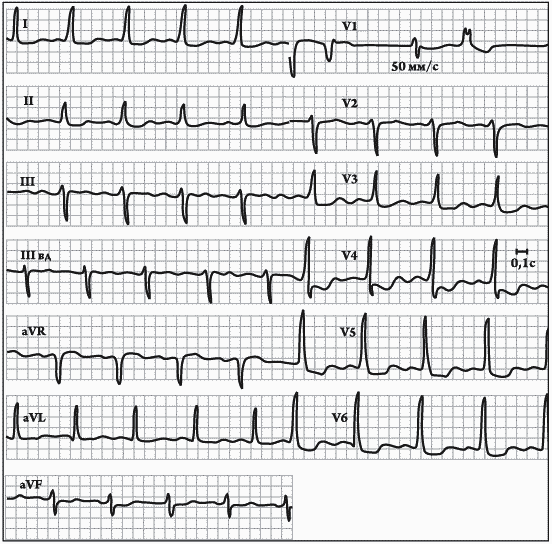 Гликозидная интоксикация. Отравление сердечными гликозидами ЭКГ. Гликозидная интоксикация на ЭКГ. Интоксикация гликозидами на ЭКГ. Гликозидная интоксикация ЭКТ.
