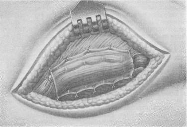 Свободный лоскут. 5. Операции при вентральных грыжах.. Грыжа операция шубегейкера. Грыжа брюшная операция пластина. Фасция члена лоскут макканича.