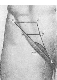 Бедренная складка. Паховый треугольник топография. Паховый треугольник Гессельбаха. Пахово бедренная складка. Паховый треугольник и промежуток.