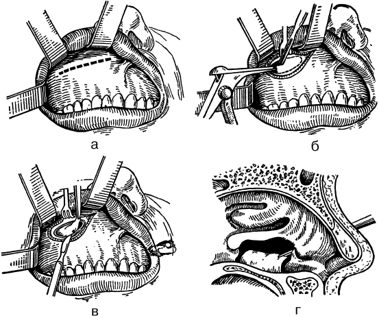 Лоскут зубы. Трепанация верхнечелюстной пазухи по Колдуэлл-люку. Радикальная гайморотомия по Калдвеллу - люку. Гайморотомия радикальная операция. Схема операции по Колдуэллу-люку.