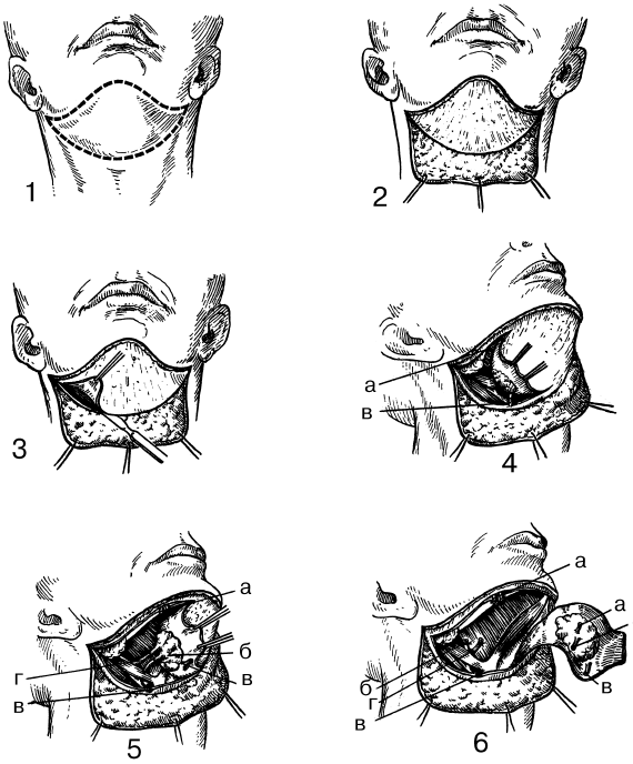 Шейные операции. Операция Ванаха и Крайля. Операция Ванаха методика. Операция Ванаха этапы топографическая анатомия.