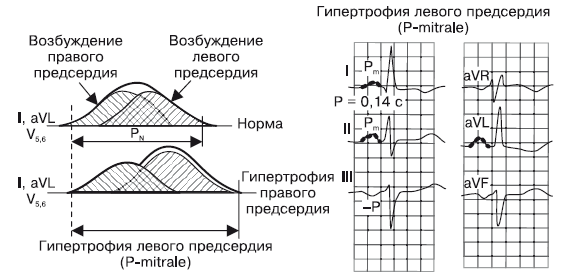 Гипертрофия правого предсердия на экг. При гипертрофии левого предсердия на ЭКГ характерно:. Гипертрофия правого и левого предсердия на ЭКГ. Признаки гипертрофии левого предсердия на ЭКГ. Гипертрофия левого предсердия на ЭКГ.