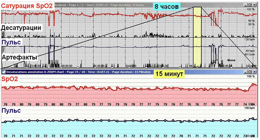 Сатурация у лежачих