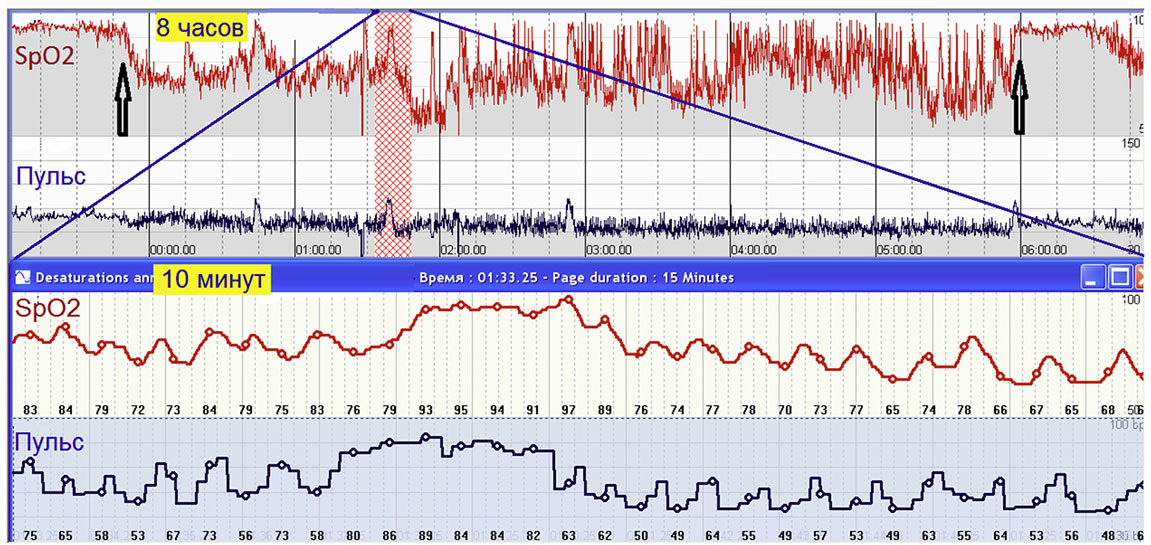 Сатурация во время сна. Сатурация во время сна. Индекс апноэ гипопноэ. Степени апноэ сна. Полисомнография показатели.