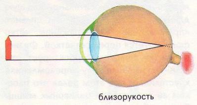 Неравенство величин изображения одного и того же предмета на сетчатке