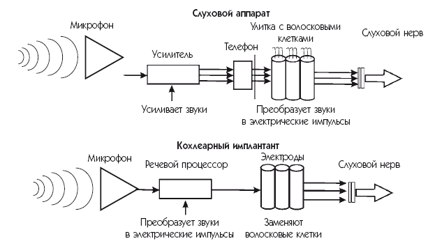 Схема работы кохлеарного импланта