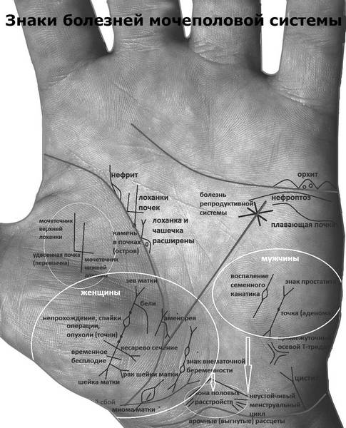Болезни по ладоням рук определение в картинках
