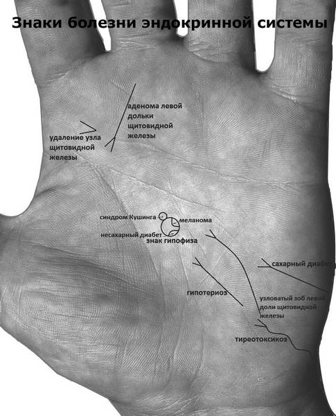 Знаки онкологии на ладони хиромантия фото