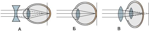 На рисунке 10 приведены схемы хода лучей в глазе при близорукости